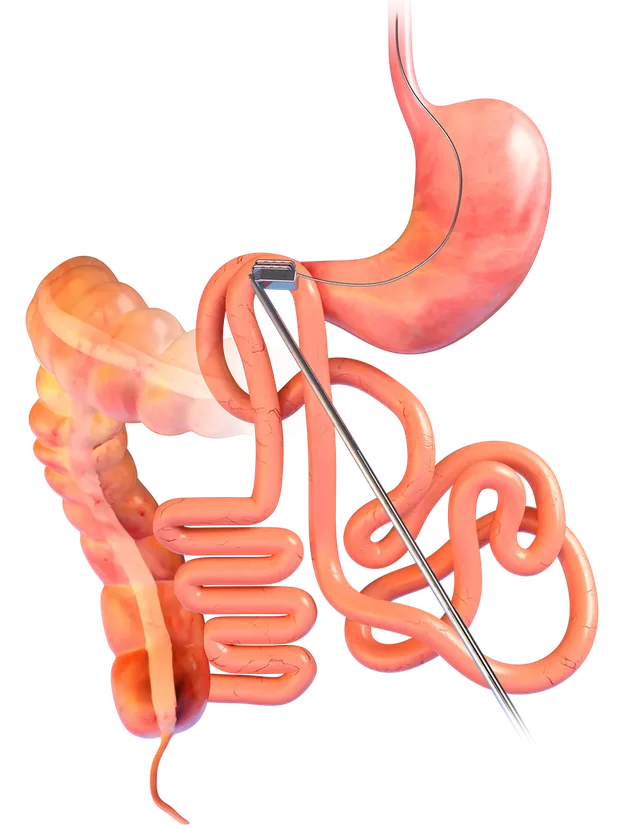 Drawing of the gut, with the two small magnets meeting between two parts of it